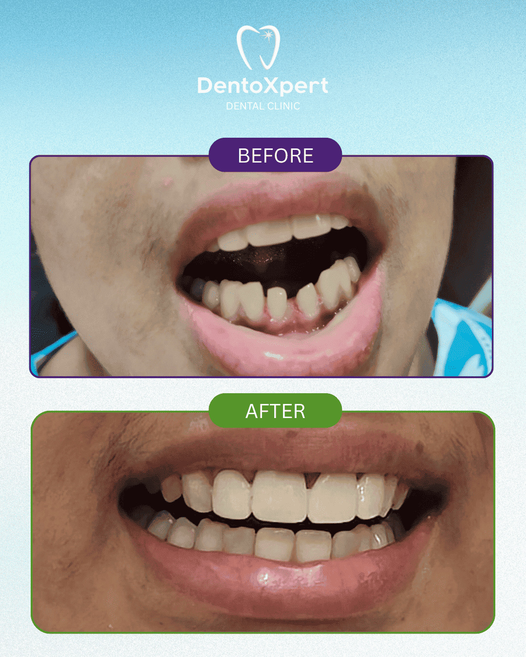 Before and after dental treatment result at DentoXpert Dental Clinic in Thane